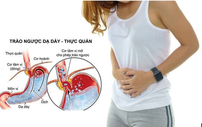 Trào ngược dạ dày thực quản