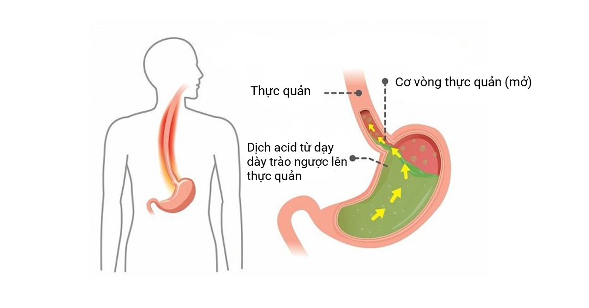 Tìm hiểu thuốc chống trào ngược dạ dày thực quản